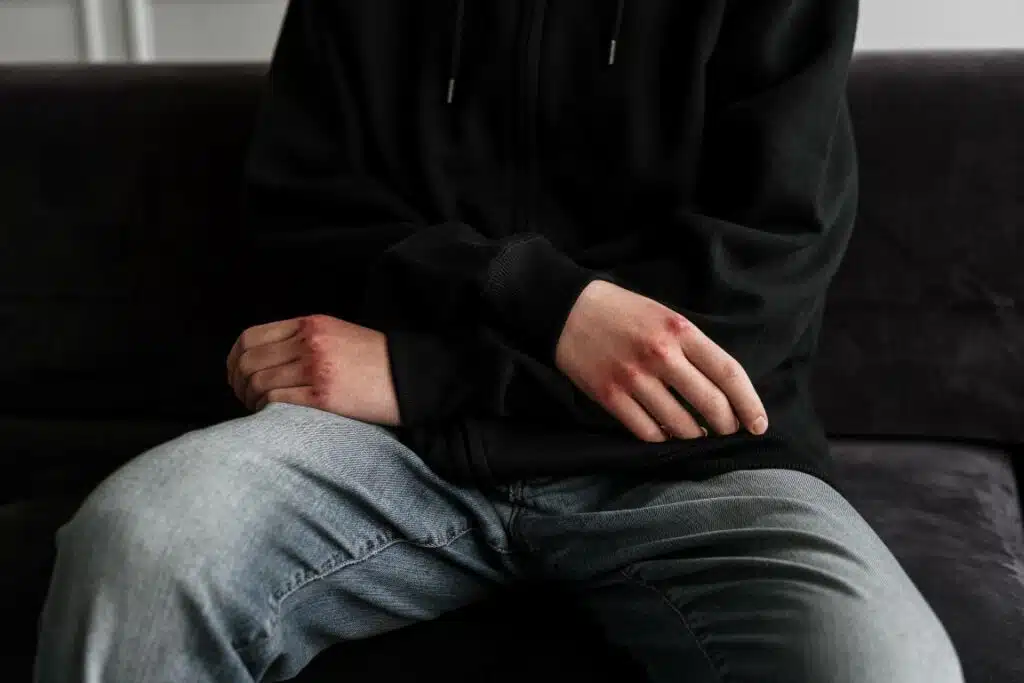 Trauma response - increased aggression and anger - Teen boy shows signs of wounds on knuckles 